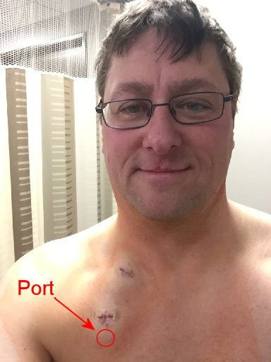 What Is a Chemo Port?